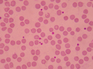 Large platelets on blood smear.