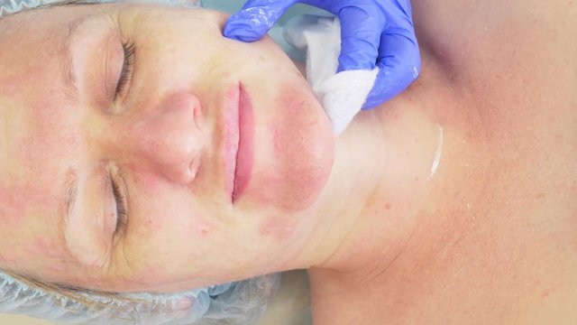 procedure for cleaning the face in the doctor's office of a dermatologist. 4k, close-up, slow-motion . Squeezing the infected pustulous acne to inoculation