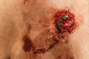 Fototapeta premium Flesh wound with blood on male foot closeup