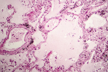 Histopathology of acute pulmonary edema, light micrograph showing accumulation of fluid inside...