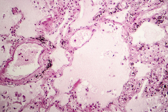 Histopathology of acute pulmonary edema, light micrograph showing accumulation of fluid inside alveoli