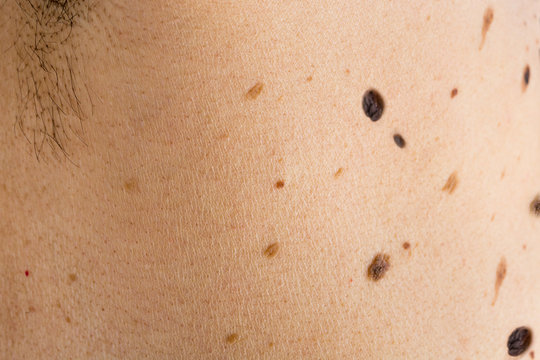 Detail of the bare skin on man in the back, Disorders of body with moles on skin growths include warts lot of wart, mole, birthmark, wart, gnarl, wart, Skin problems, Sun effect on skin.