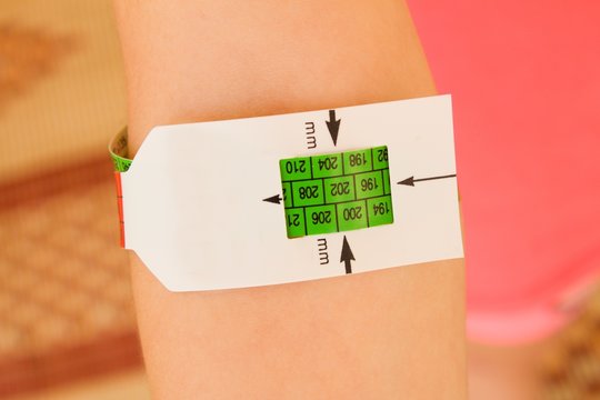 Measuring malnutrition using strap MUAC mid-upper-arm-circumference.The hand of a healthy well-fed child.