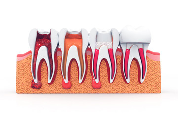 stages of root canal treatment