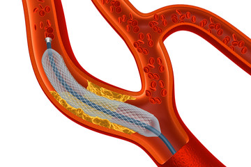 Balloon Expandable Stent. Anatomical concept - obrazy, fototapety, plakaty