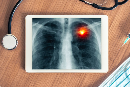 Top view on a digital tablet on a medical desk with x-ray of pain in lung. Stethoscope, syringe and hygienic mask on the desk
