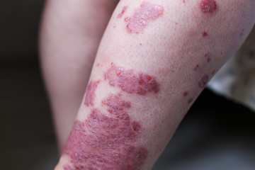 Fototapeta premium Psoriasis vulgaris is an autoimmune disease that affects the skin, detail photography for mainly medical magazines. Atopic dermatitis or eczema, is a type of inflammation of the skin at foot.