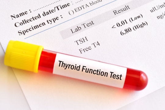 Blood sample tube with abnormal thyroid hormone test result from hyperthyroidism patient