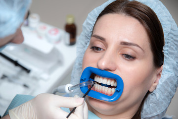 Preparing the oral cavity for whitening with an ultraviolet lamp. Close-up