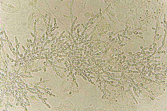 Pseudohyphae and budding yeast cells in patient urine 