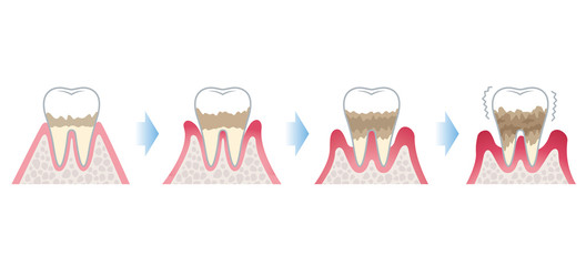 歯周病の進行