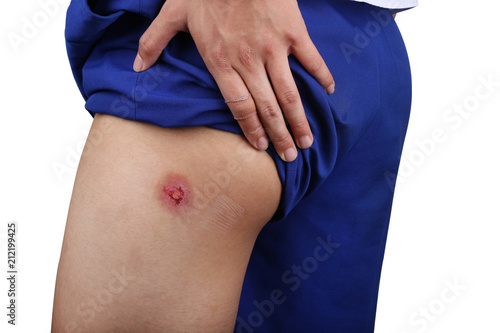 Bruised Wound Injury On Skin Butt Or Skin Bum Of Asian Young Boy Close Up Bleeding Wound On Ass Isolated On White Background Bruised Wound Injury On Skin Butt Or Skin Bum Of Asian Young Boy Close Up Bleeding Wound On Ass Isolated On White Background