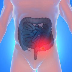 3d illustration of colorectal cancer