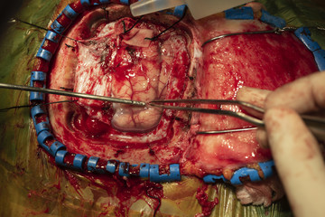 Doctor performing brain surgery in operating room