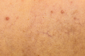 Fototapeta premium Ski with dilated capillaries ad red spots