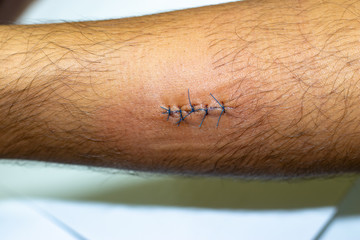 Scar from operation with a blue fiber on man arm.