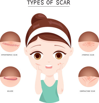 Types of  scar