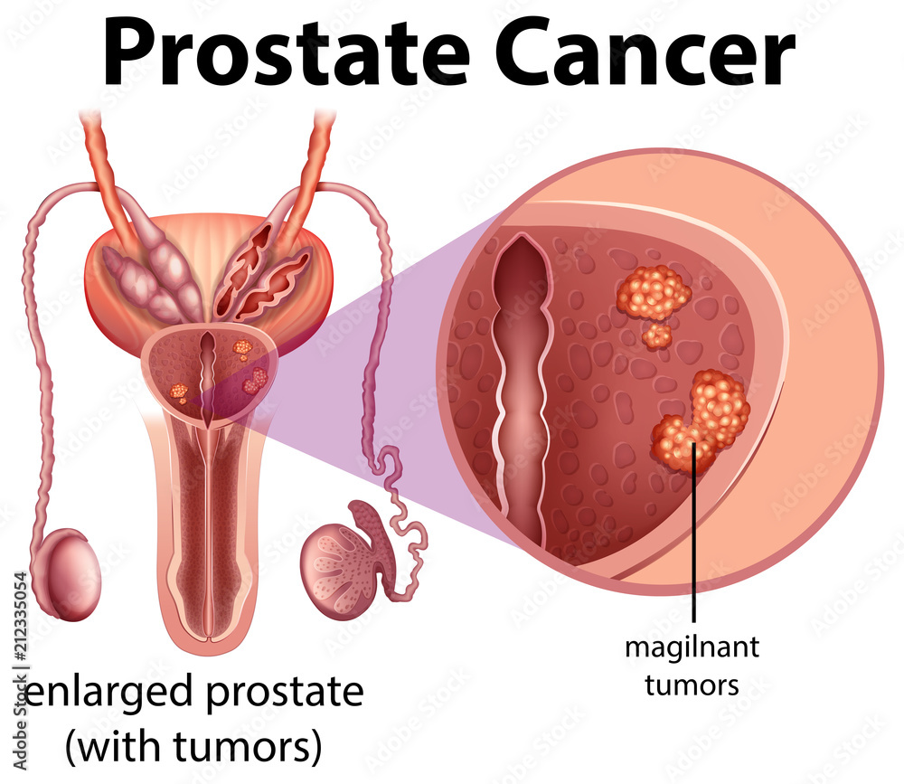 Poster Male Prostate Cancer diagram