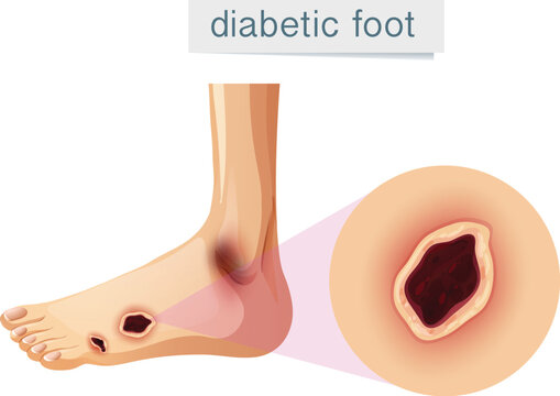 Diabetic foot magnifed on foot