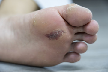 close-up on foot corn with bruise