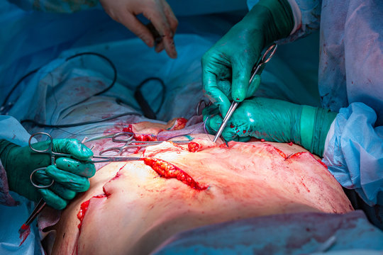 Surgical operation abdominoplasty