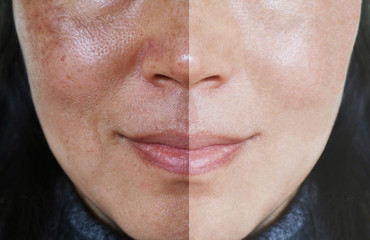 Face with open pores and melasma before and after make up or treatment concept.