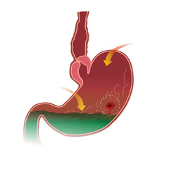 Stomach peptic ulcer.