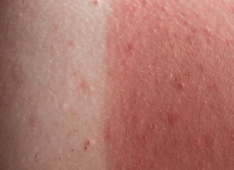 red skin from sunburn
