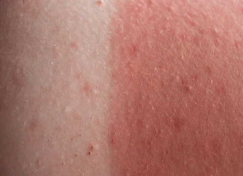 red skin from sunburn
