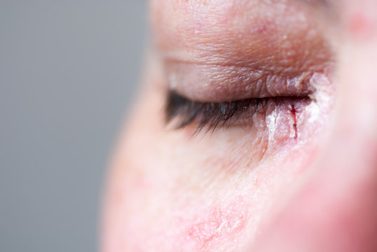 Psoriasis