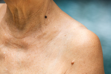 Senior woman have Brown mole on brachium,  Black mole on neck , Medicine, Close up