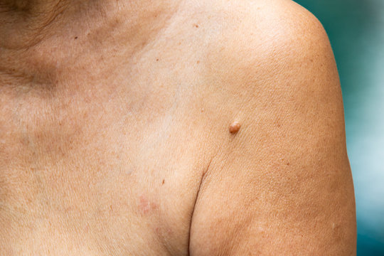 Brown mole on senior woman's  brachium, Medicine, Close up