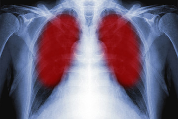 x-ray film of lungs
