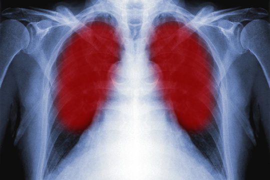 x-ray film of lungs