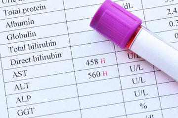 Abnormal high liver enzyme test result with blood sample tube