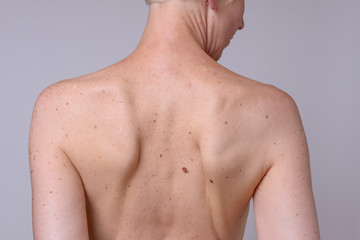 Naklejka premium The back of a woman with many liver spots