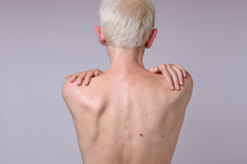 The back of a woman with many liver spots