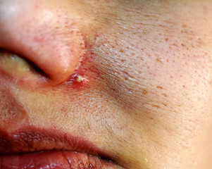 Inflamed skin of the face. Acne. Pimple purulent on the nose.