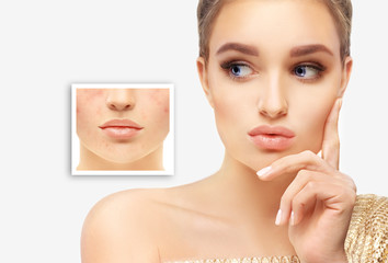 Post-Acne Marks /Treating Acne Scars