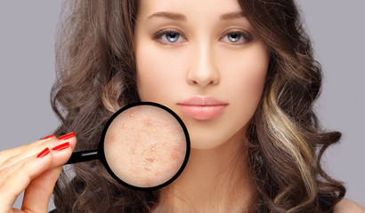 Post-Acne Marks /Treating Acne Scars