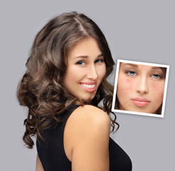 Post-Acne Marks /Treating Acne Scars