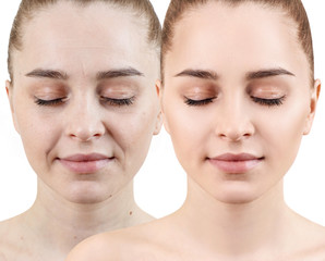 Woman face before and after rejuvenation.