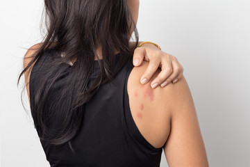 woman showing her skin itching behind , with allergy rash urticaria symptoms