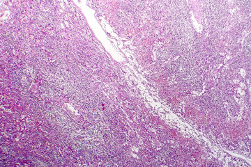 Hemorrhagic lymphadenitits, lymph node inflammation and hemorrhage, light micrograph, photo under microscope