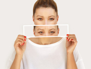 Lower blepharoplasty..Before and after cosmetic procedures,showing photos