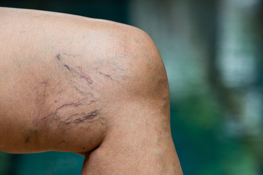 Varicose veins on a leg in Senior woman