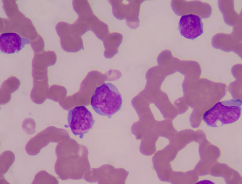 Blood smear show immature white blood cells.