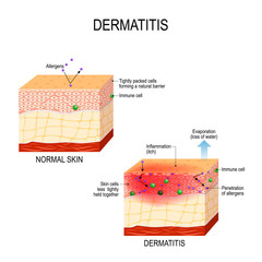 Atopic dermatitis (eczema) - obrazy, fototapety, plakaty