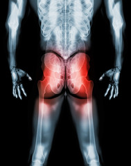Hip painful skeleton x-ray, 3D illustration.