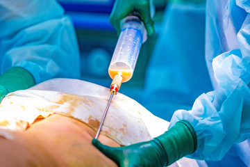 cosmetic liposuction surgery in actual operating room setting showing surgeon hands and cannula - obrazy, fototapety, plakaty